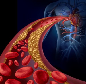 Clogged artery and atherosclerosis disease medical concept with a three dimensional human artery with blood cells that is blocked by plaque buildup of cholesterol as a symbol of arteriosclerotic vascular diseases.